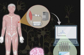 肌内肌电图的新应用可能有助于检测神经肌肉疾病