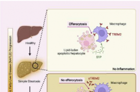 免疫学家发现与肥胖相关的严重肝病诱因
