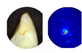 通过无损红外成像实现更好的牙腔诊断