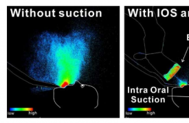 LED 成像直观地证实了口腔吸引装置在减少液滴和气溶胶方面的功效
