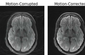 研究人员将深度学习和物理学结合起来修复运动损坏的 MRI 扫描