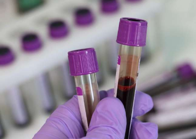 新的血液检测可检测帕金森病的关键指标