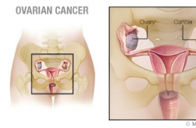 卵巢癌的新手术方法照亮了病灶