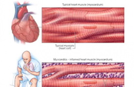 什么是心肌炎